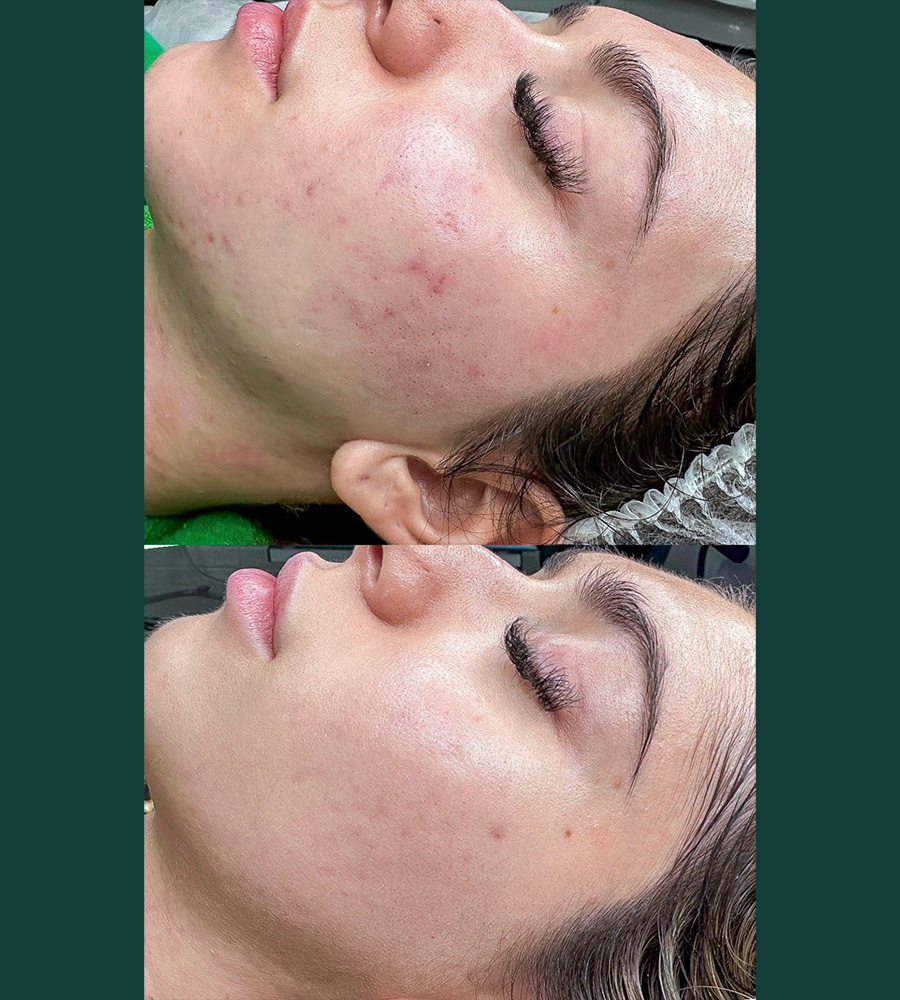 Stop Acne